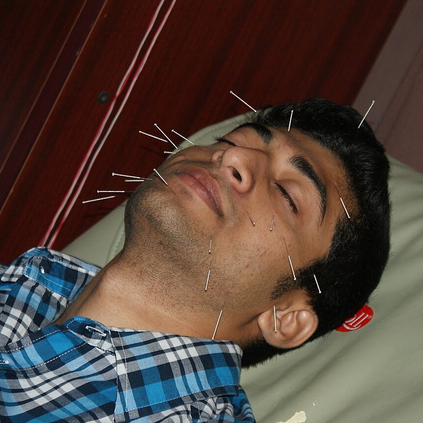Acupuntura